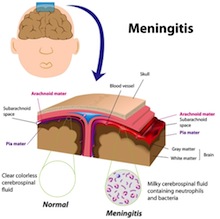 Meningococcal Meningitis Symptoms In Adults